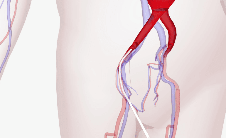Angioplastias arteriales y venosas en Guadalajara - Innovación en Salud Vascular