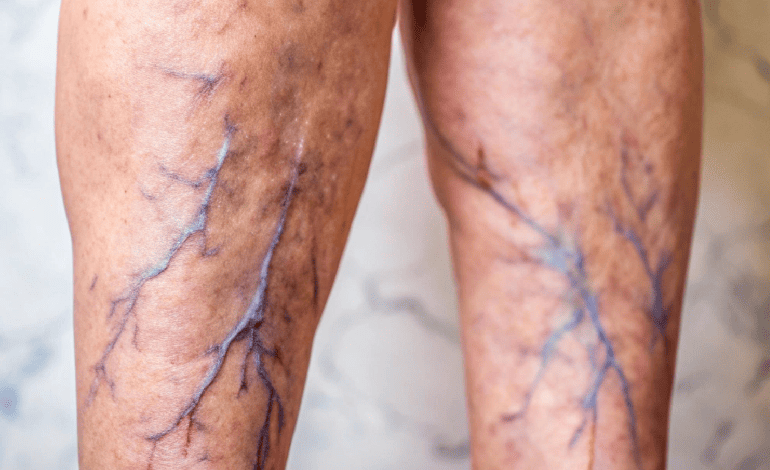 Tratamiento en malformaciones vasculares en Guadalajara - Soluciones Avanzadas