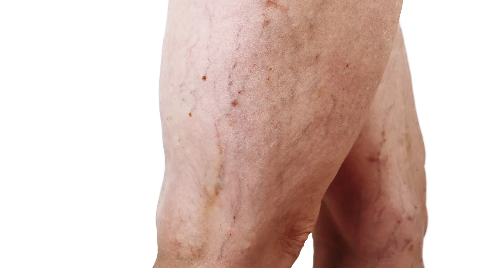 Edema en piernas: Diagnóstico y manejo especializado en Guadalajara