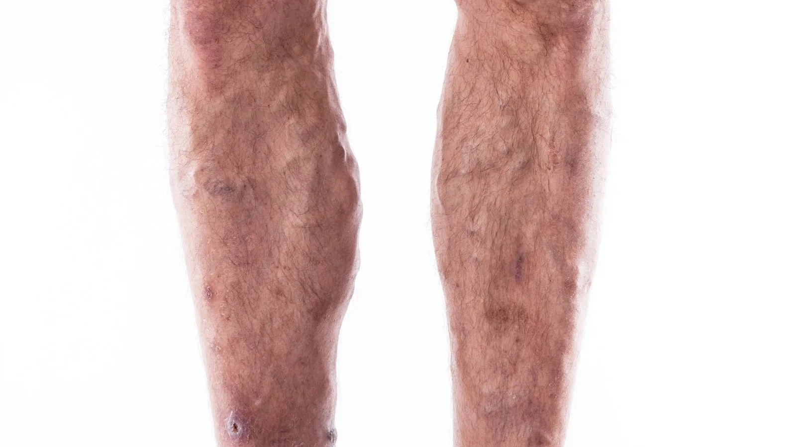 Embolia arterial: Atención de urgencia vascular en Guadalajara