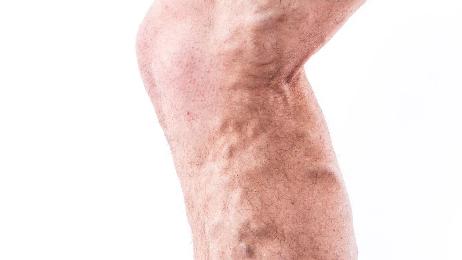 Trombosis venosa profunda: Especialistas en salud vascular en Guadalajara