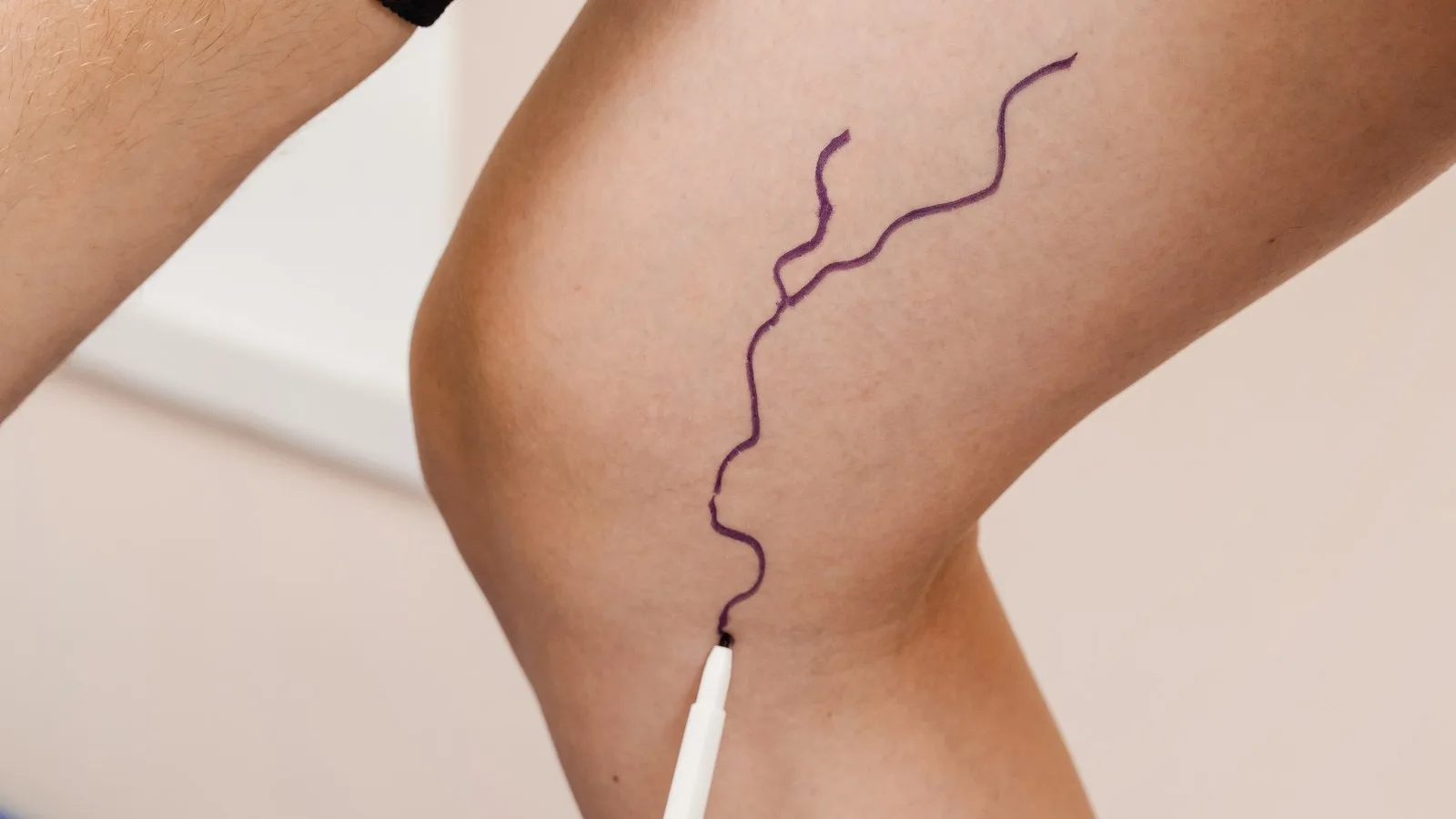 qué médico trata úlceras vasculares