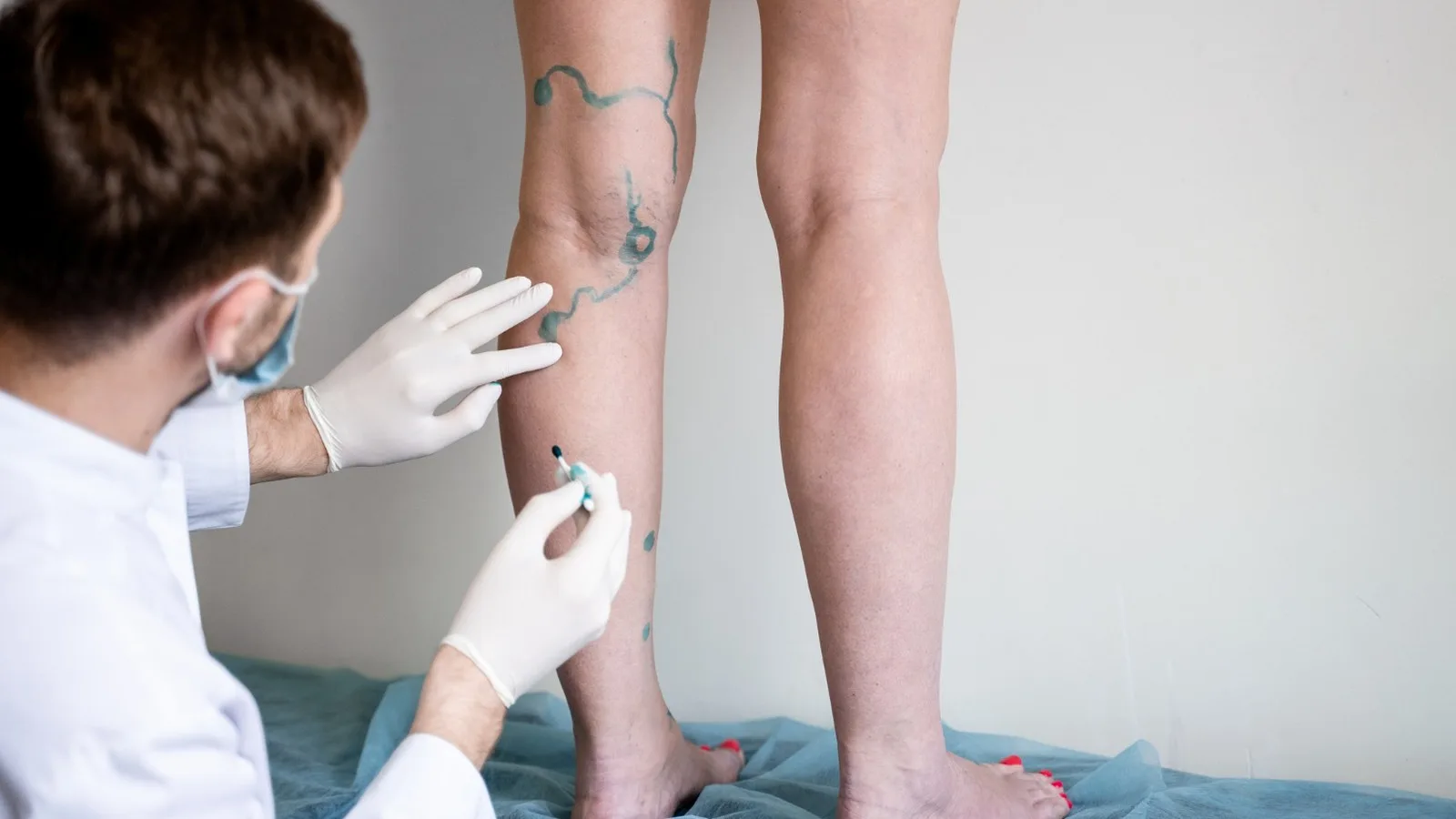 qué médico trata úlceras venosas